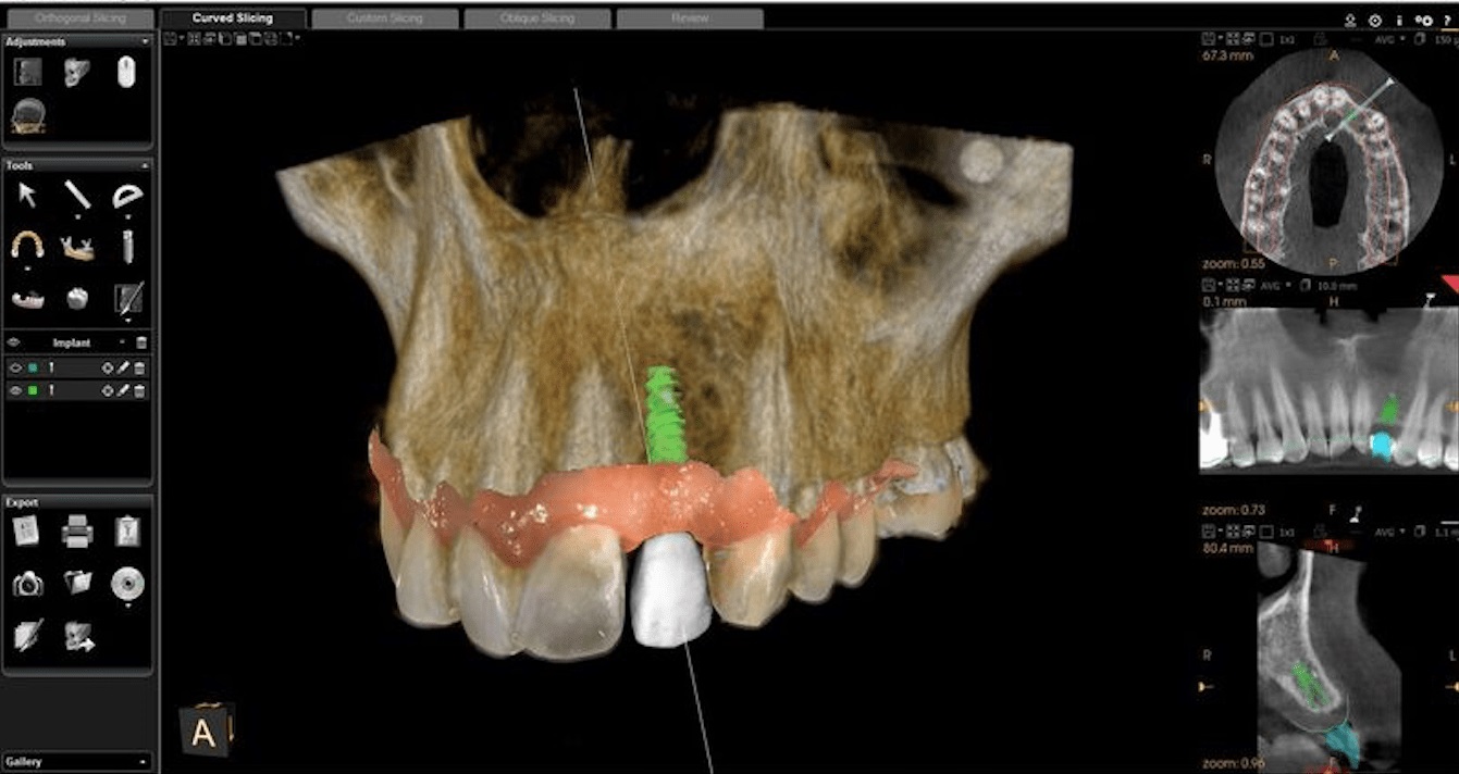 Implantes Dentales