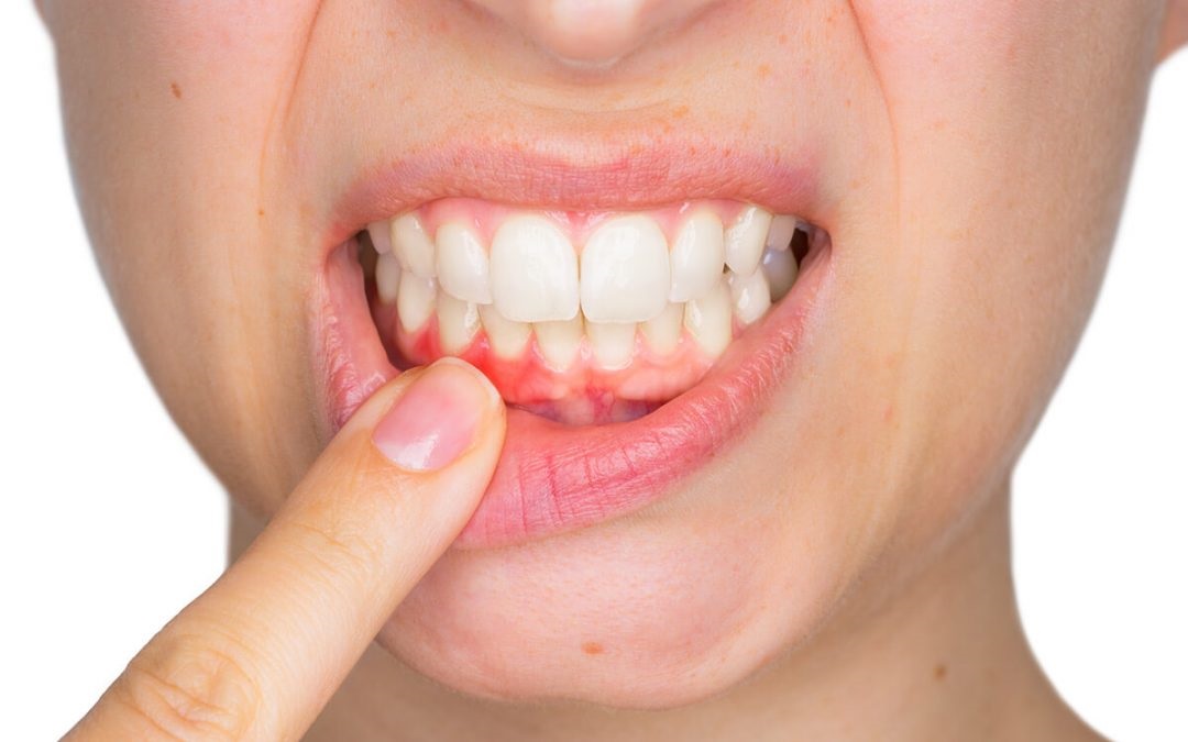 Tratamiento Periodontal